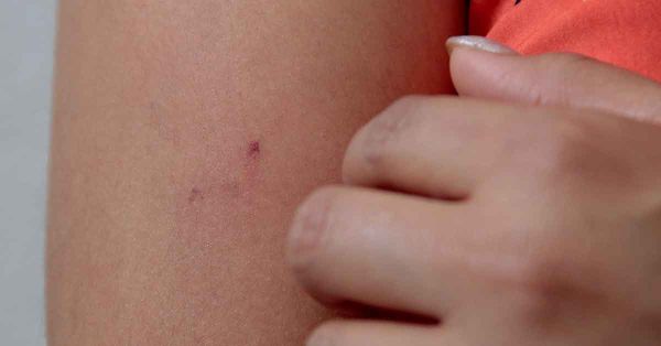 Se suma ISSSTEP al combate de paludismo