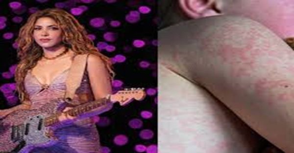 Alertan por un posible contagio masivo de sarampión, tras Concierto de Shakira en Nueva Jersey