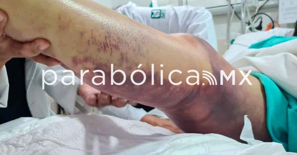 Sobrevive a mordedura de v&iacute;bora por atenci&oacute;n especializada en el IMSS en CDMX