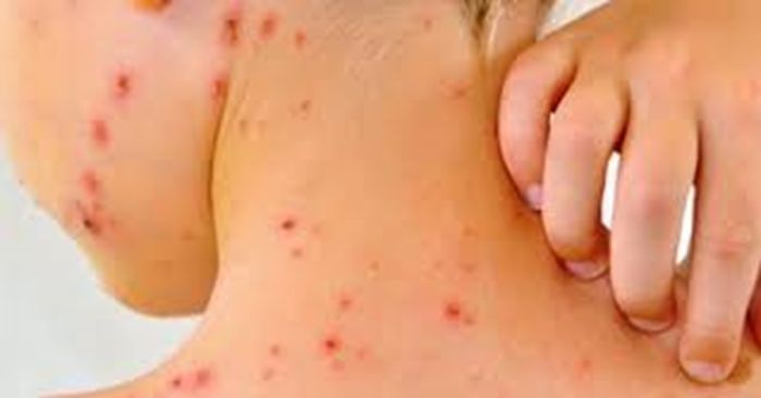 Alerta en M&eacute;xico por 4 mil casos de sarampi&oacute;n en lo que va del a&ntilde;o