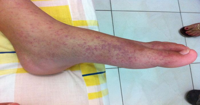 Suman en China 7 mil casos de chikungunya