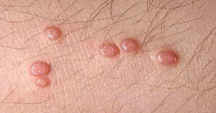 Esto sabemos del molusco contagioso; es un nuevo virus