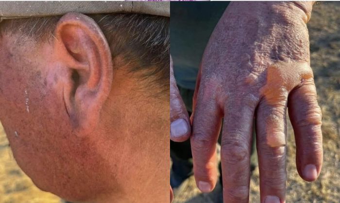 Padecen brigadistas de Tlachichuca los efectos del combate a incendios forestales