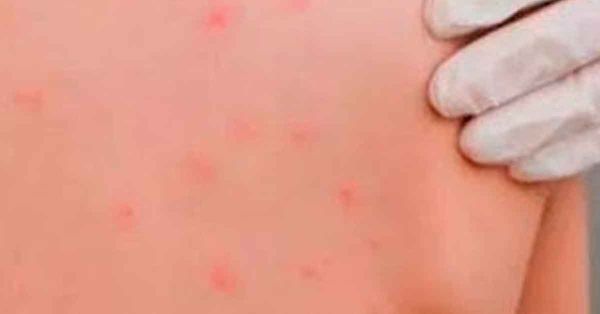 Suman 8 mil 500 casos de sarampi&oacute;n a nivel nacional; la mitad en Chihuahua