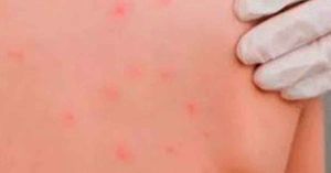 Confirma Salud segundo caso de sarampi&oacute;n en Puebla